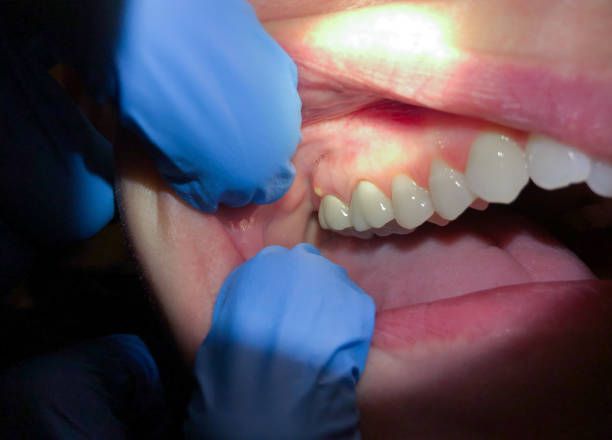 Best Knocked-Out Tooth (Avulsed Tooth) Treatment in Westville, NJ